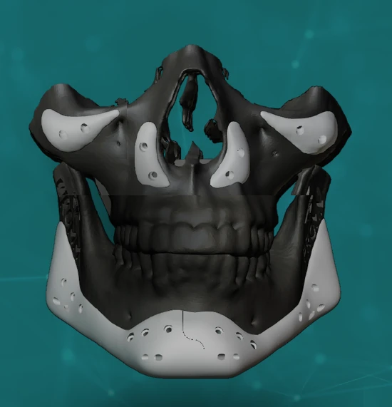 Implante facial personalizado planejado em três dimensões