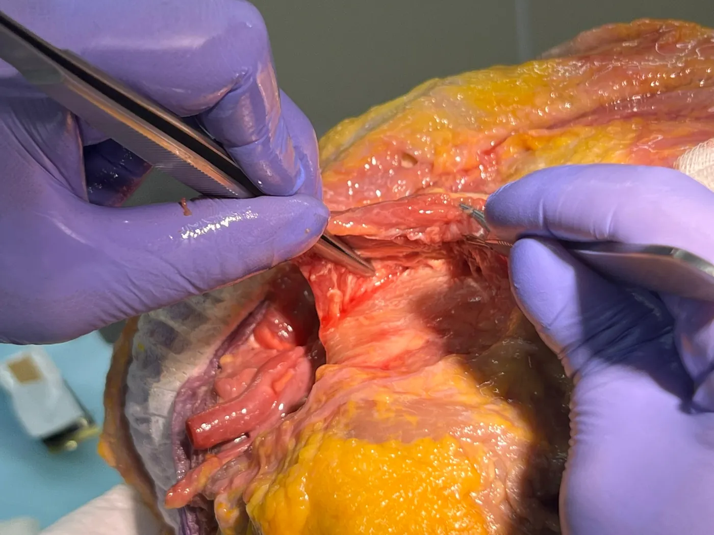 Dissecção em peça anatômica Fresh Frozen